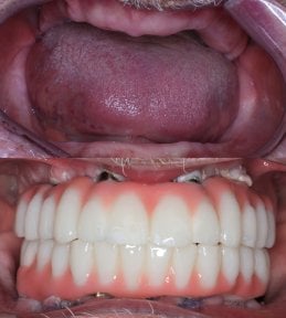 Результат до та після імплантації All-on-4 у VBright Dental – повне відновлення посмішки