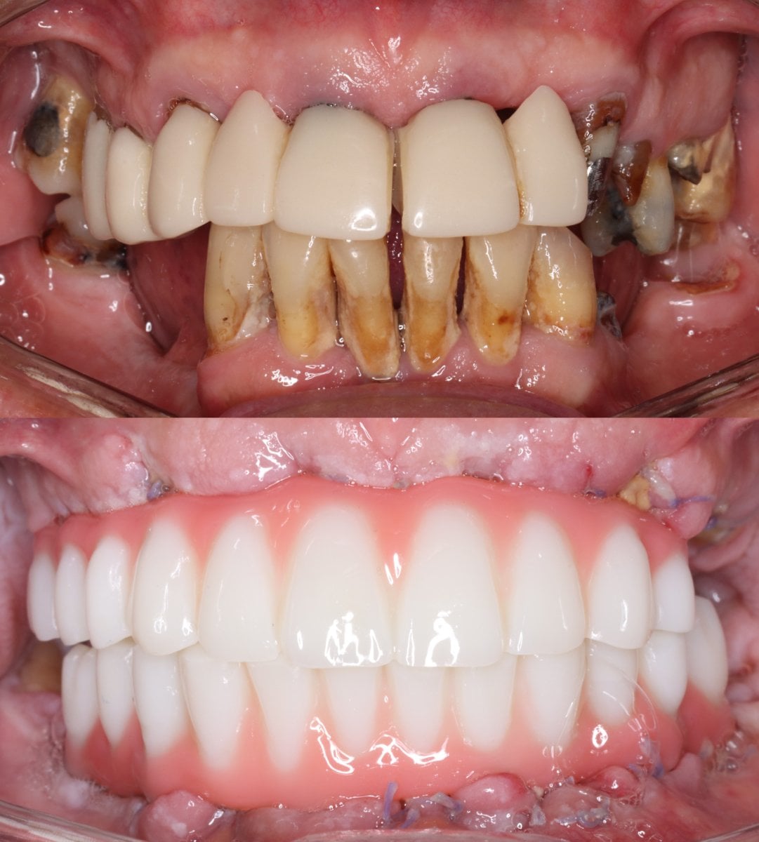 نتيجة قبل وبعد زراعة الأسنان All-on-4 في VBright Dental، استعادة الابتسامة الكاملة