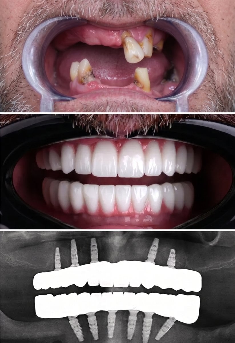 Resultado antes y después de implantes dentales All-on-4 en VBright Dental – sonrisa restaurada