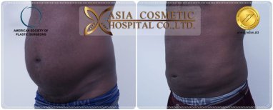 قبل وبعد نحت البطن في Asia Cosmetic Hospital، نتيجة تحديد عضلات البطن