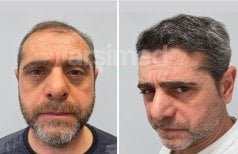 Before and after hair transplant results at Hisar Hospital Intercontinental, restored hairline