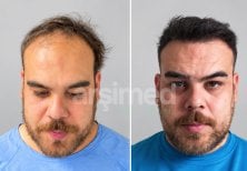 Before and after hair transplant results at Hisar Hospital Intercontinental, restored hairline
