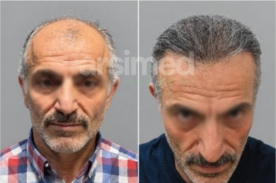 Before and after hair transplant results at Hisar Hospital Intercontinental, restored hairline