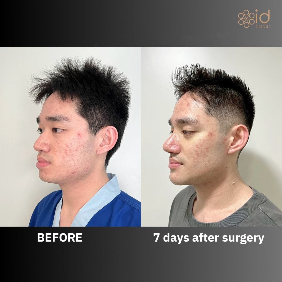 Antes y después de implante de mentón en ID Clinic Bangkok, resultado visible tras 7 días