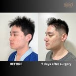 Before and after chin implant at ID Clinic Bangkok, visible chin enhancement result after 7 days