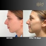 Результаты до и после имплантации подбородка в ID Clinic Bangkok, улучшенный профиль за 14 дней