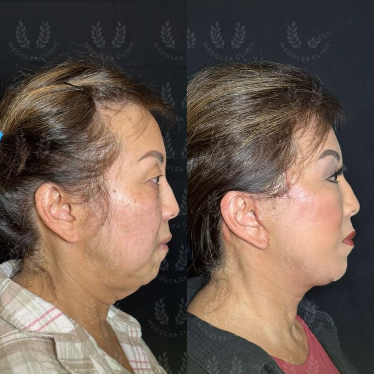 Resultados antes y después de deep plane facelift en Dr. Safa Manav Clinic, rejuvenecimiento facial