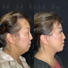 Before and after deep plane facelift results at Dr. Safa Manav Clinic, visible facial rejuvenation