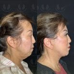 Before and after deep plane facelift results at Dr. Safa Manav Clinic, visible facial rejuvenation