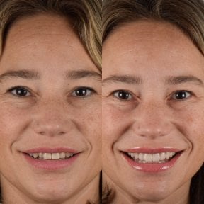 before-after photo installation-of-a-veneer