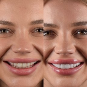 before-after photo installation-of-a-veneer