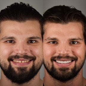 before-after photo installation-of-a-veneer