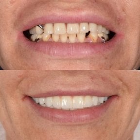 before-after photo denture