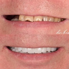 before-after photo denture