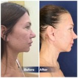 Результаты до и после Deep Plane Facelift в Intrarat Hospital, видимое омоложение лица