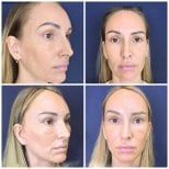 Результаты до и после Deep Plane Facelift в Intrarat Hospital, видимое омоложение лица