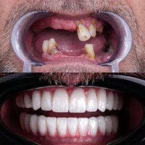 Resultados antes y después de implantes All-on-4 en VBright Dental – restauración total de sonrisa