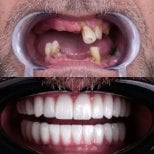 Resultados antes y después de implantes All-on-4 en VBright Dental – restauración total de sonrisa