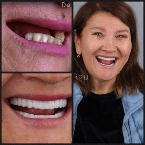 نتائج قبل وبعد زراعة الأسنان All-on-4 في عيادة Dentaray، استعادة الابتسامة