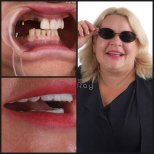 نتائج قبل وبعد زراعة الأسنان All-on-4 في عيادة Dentaray، استعادة الابتسامة