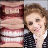 نتيجة قبل وبعد زراعة الأسنان All-on-4 في عيادة Dentaray، ابتسامة مستعادة