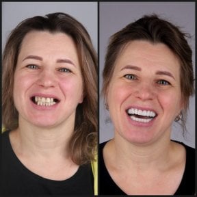 نتيجة قبل وبعد زراعة الأسنان All-on-4 الموجهة بالحاسوب في عيادة Dentaray