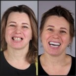 نتيجة قبل وبعد زراعة الأسنان All-on-4 الموجهة بالحاسوب في عيادة Dentaray