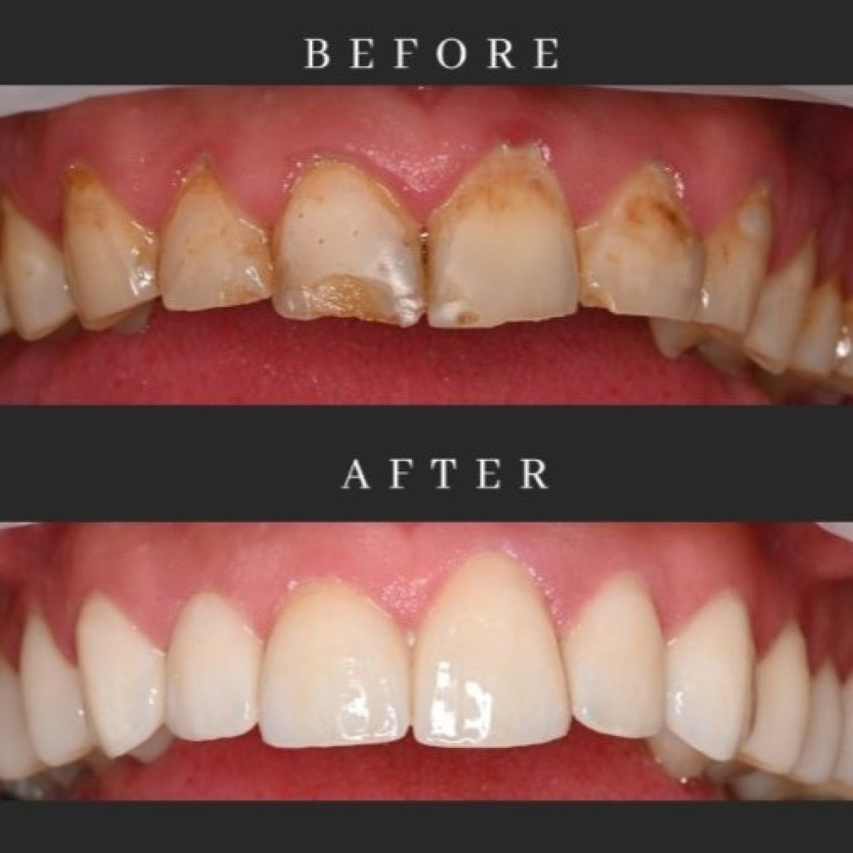 Resultados de restauración dental (bonding) antes y después en Dental Club Karadjovi, sonrisa mejorada