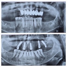 before-after photo all-on-4-dental-implants
