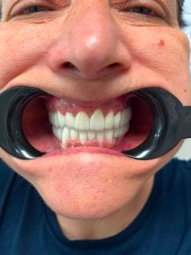 before-after photo all-on-4-dental-implants