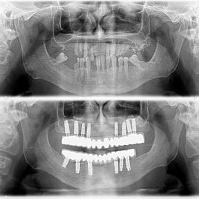 before-after photo all-on-4-dental-implants