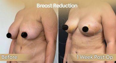 before-after photo breast-reduction