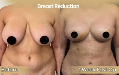 before-after photo breast-reduction