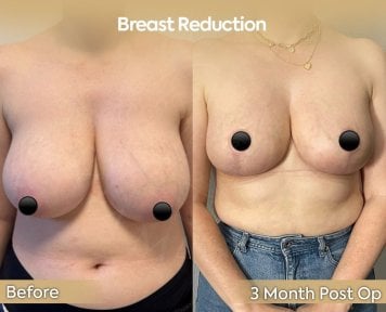 before-after photo breast-reduction