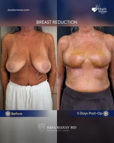 before-after photo breast-reduction