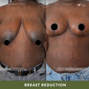 before-after photo breast-reduction