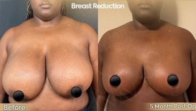before-after photo breast-reduction