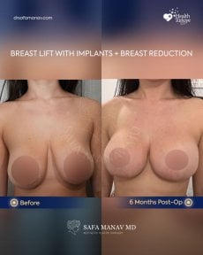 before-after photo breast-reduction
