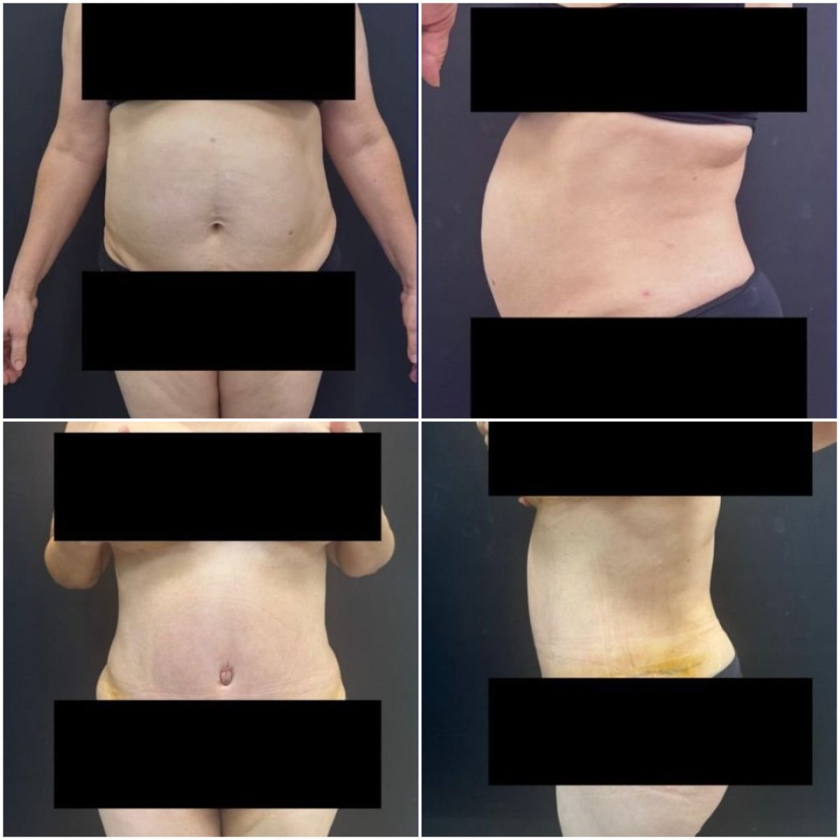نتائج شد البطن والشفط قبل وبعد في Dr. Fabiano Arruda – Plastic Surgery