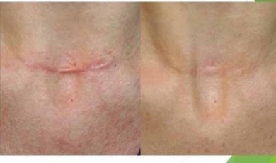 before-after photo scar-revision