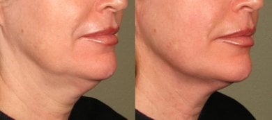 Результати до і після Ultherapy в клініці Altos – підтяжка підборіддя та шиї