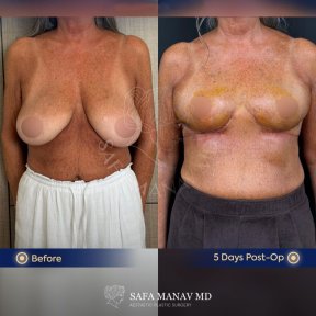 before-after photo breast-reduction