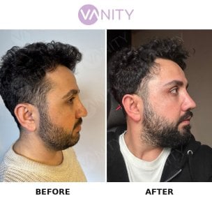 before-after photo rhinoplasty-nose-job