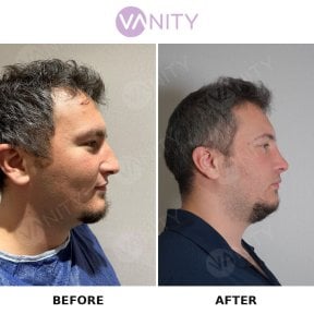 before-after photo rhinoplasty-nose-job