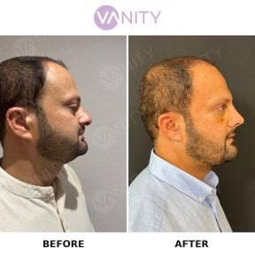 before-after photo rhinoplasty-nose-job