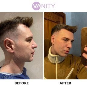 before-after photo rhinoplasty-nose-job