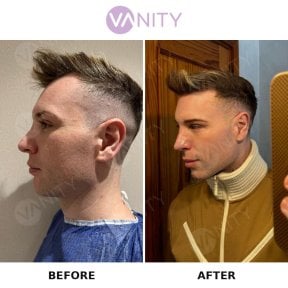 before-after photo rhinoplasty-nose-job