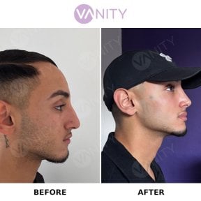 before-after photo rhinoplasty-nose-job