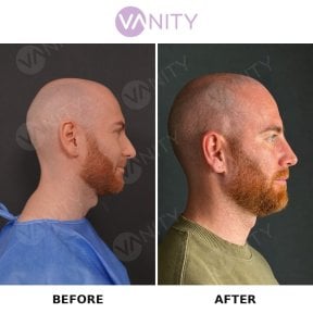 before-after photo rhinoplasty-nose-job