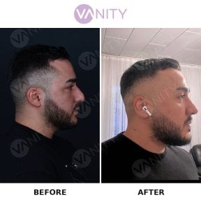 before-after photo rhinoplasty-nose-job
